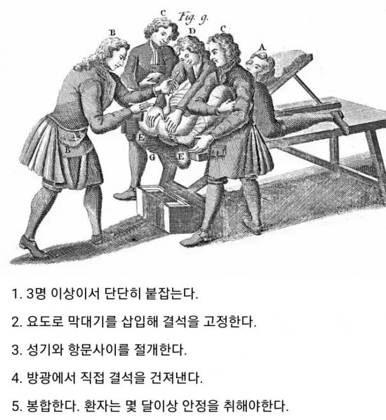 마틴 루터 요로결석 썰 · 2번째 이미지