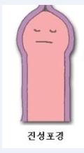 어쩔수 없이 포경을 해야되는 케이스.jpg