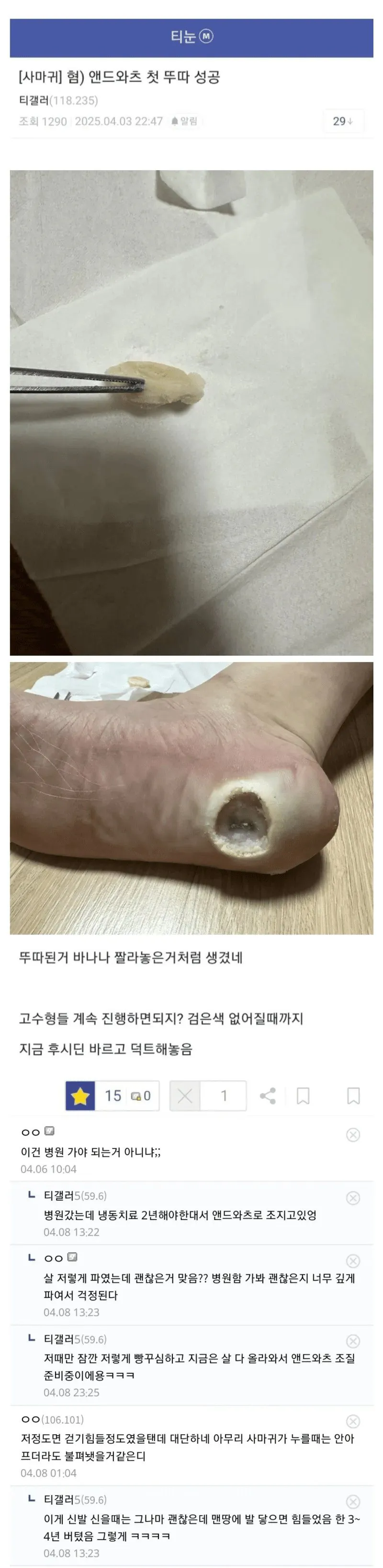 (혐) 발꿈치를 통째로 뽑아낸 인간 · 1번째 이미지